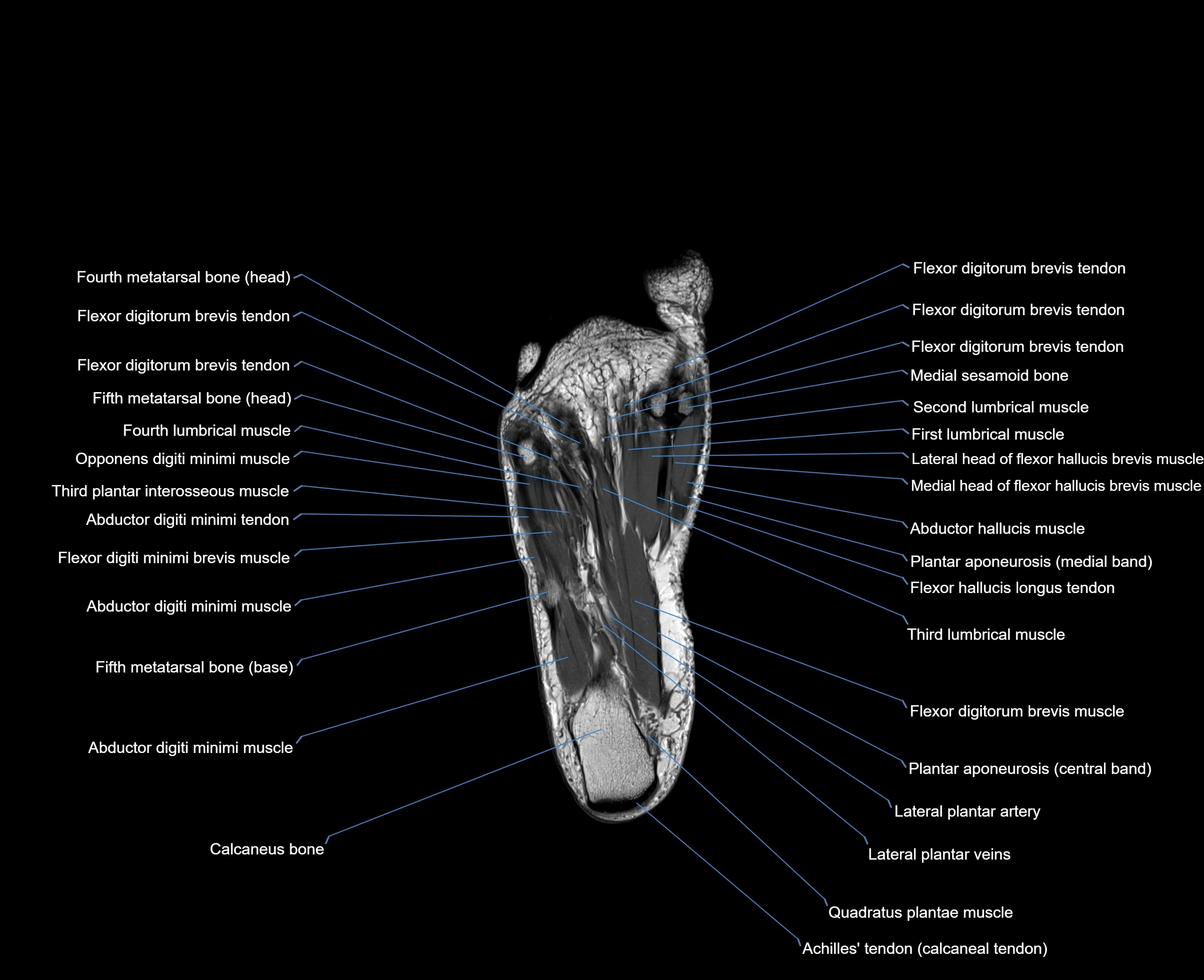 MRI foot coronal cross sectional anatomy 3T  radiology  image-img-00001-00027.webp